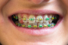 What Kind Of Braces Are For You?