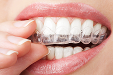 Properly Caring For Your Clear Aligners