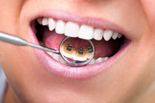 Are Lingual Braces For You?